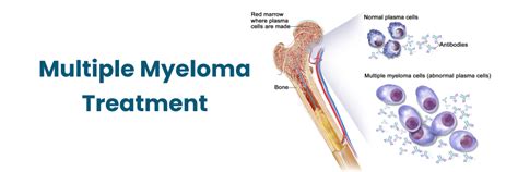 best multiple myeloma treatment centers.
